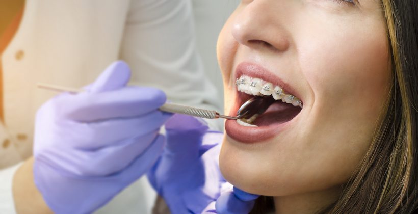 5 cosas que hay que tener en cuenta al plantearse una ortodoncia