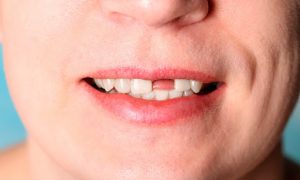 Razones clave para sustituir los dientes que faltan